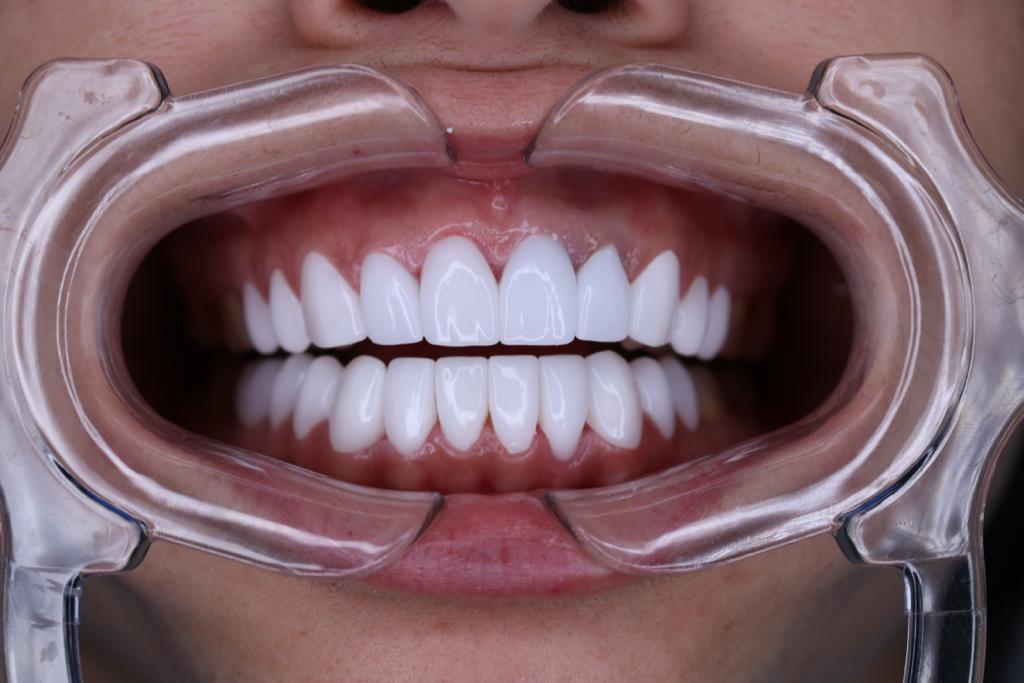 Porcelain Veneers Dental Design Smile