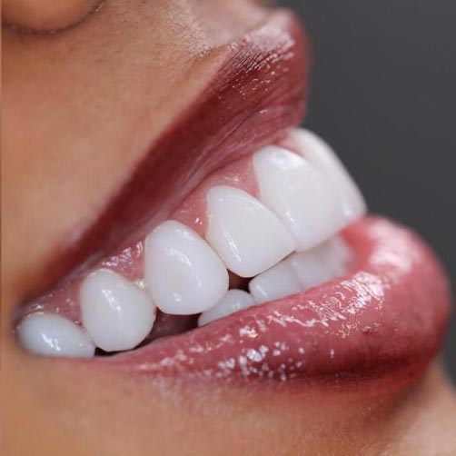 Composite Resin Veneers Dental Design Smile