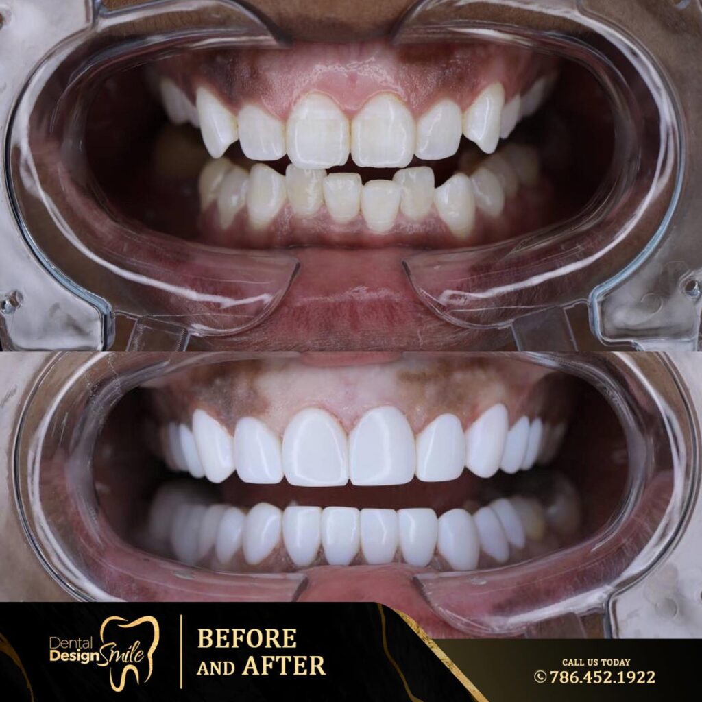 Before and after photo of dental veneers showing significant improvement in tooth appearance