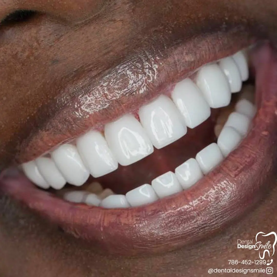 Close-up of Porcelain Veneers on Teeth After Dental Procedure