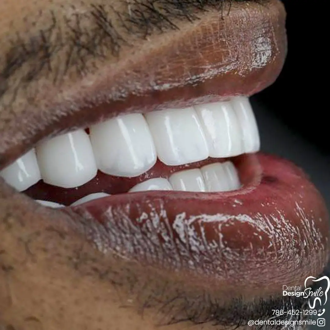 Composite Resin Veneers on Smiling Patient