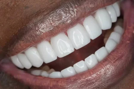 Close-up of Porcelain Veneers on Teeth After Dental Procedure