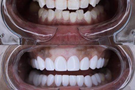 Before and after photo of dental veneers showing significant improvement in tooth appearance